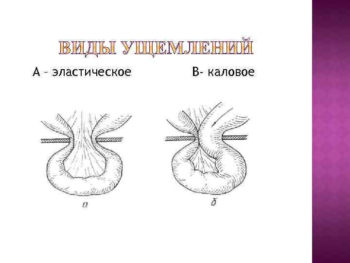 Ущемление пупочной грыжи. Эластическое ущемление грыжи. Каловая ущемленная грыжа. Эластическое и каловое ущемление грыжи. Паховая грыжа эластическое ущемление.