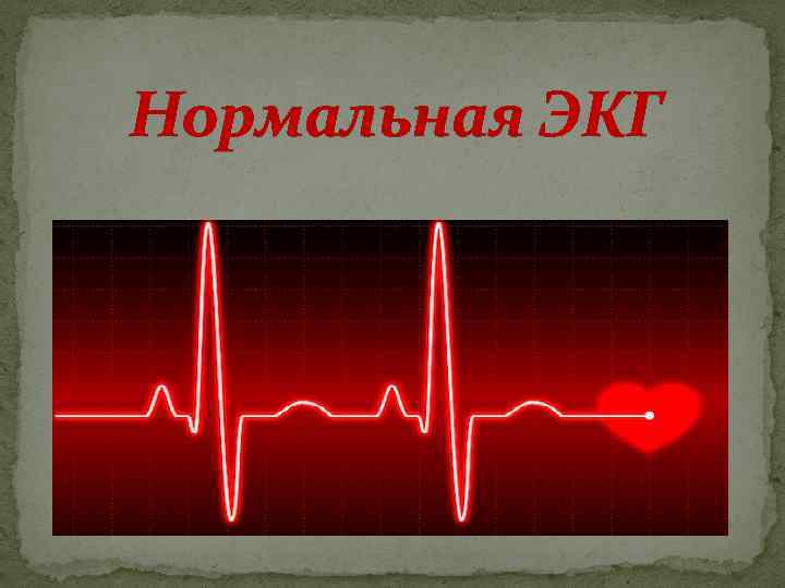 Нормальная ЭКГ 