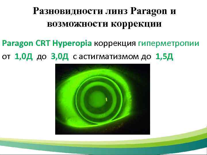 Разновидности линз Paragon и возможности коррекции Paragon CRT Hyperopia коррекция гиперметропии от 1, 0