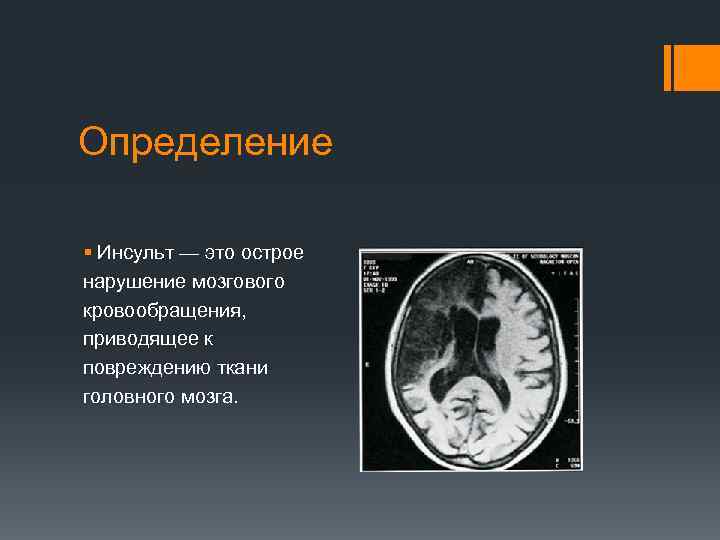 Определение § Инсульт — это острое нарушение мозгового кровообращения, приводящее к повреждению ткани головного