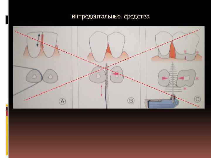 Интредентальные средства 