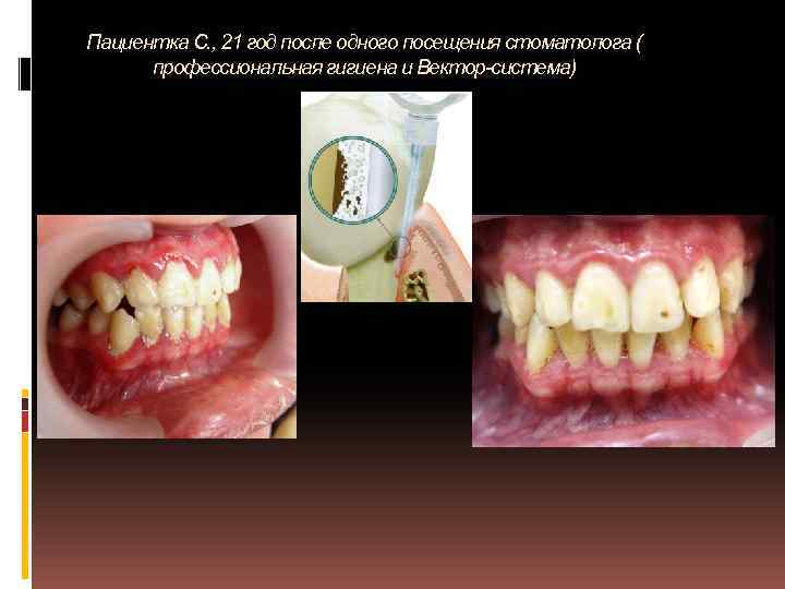 Пациентка С. , 21 год после одного посещения стоматолога ( профессиональная гигиена и Вектор-система)