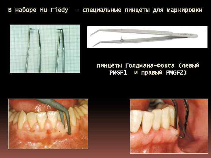 В наборе Hu-Fiedy - специальные пинцеты для маркировки пинцеты Голдмана-Фокса (левый PMGF 1 и