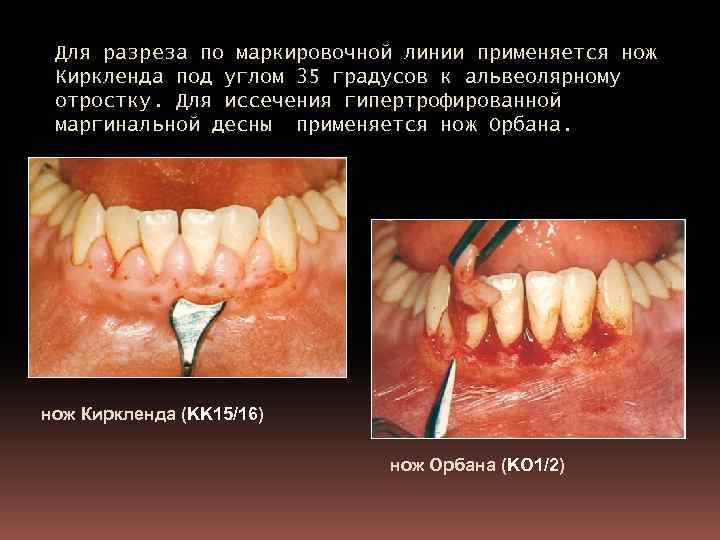 Для разреза по маркировочной линии применяется нож Киркленда под углом 35 градусов к альвеолярному