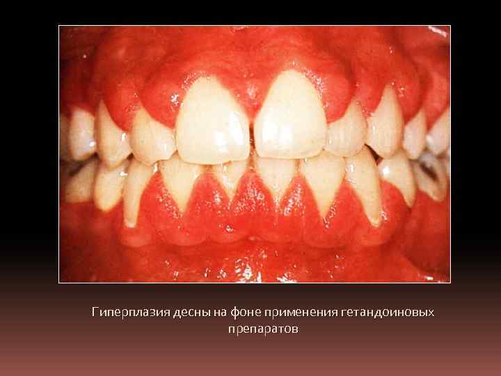 Гиперплазия десны на фоне применения гетандоиновых препаратов 