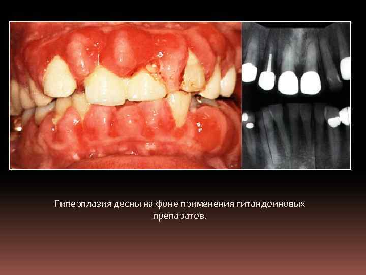 Гиперплазия десны на фоне применения гитандоиновых препаратов. 