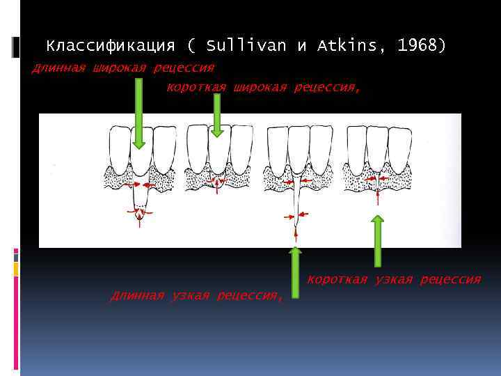 Классификация ( Sullivan и Atkins, 1968) Длинная широкая рецессия Короткая широкая рецессия, Короткая узкая