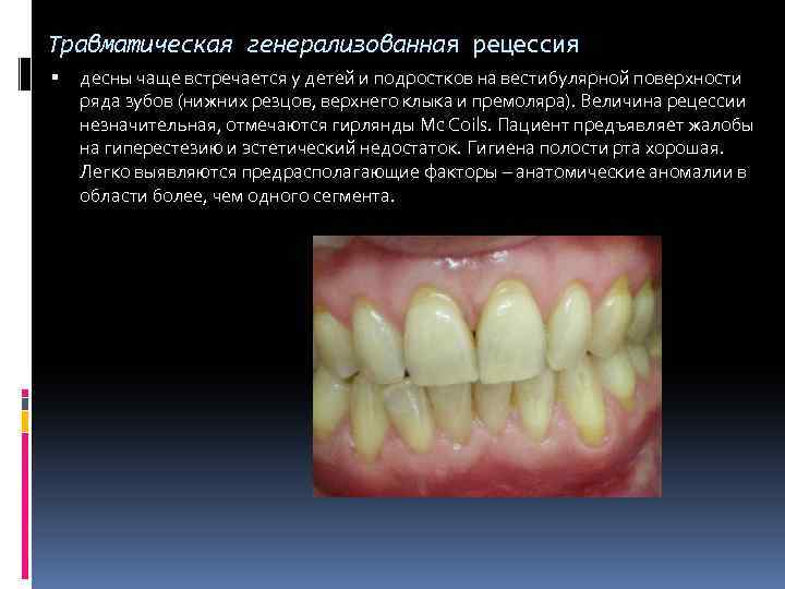 Травматическая генерализованная рецессия десны чаще встречается у детей и подростков на вестибулярной поверхности ряда