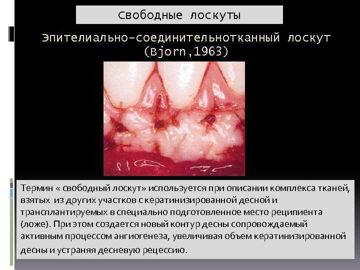 Свободные лоскуты Эпителиально-соединительнотканный лоскут (Bjorn, 1963) Свободный эпителиально-соединительный лоскут ( при рецессии не более
