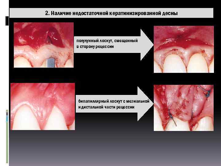2. Наличие недостаточной кератинизированной десны полулунный лоскут, смещенный в сторону рецессии бипапиллярный лоскут с
