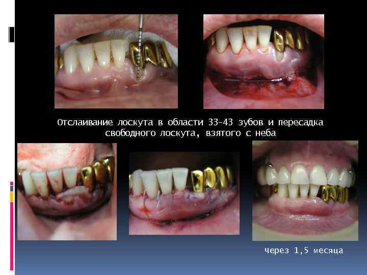 Отслаивание лоскута в области 33 -43 зубов и пересадка свободного лоскута, взятого с неба