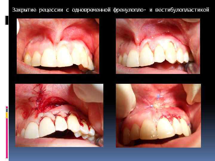 Закрытие рецессии с одновременной френулопло- и вестибулопластикой 