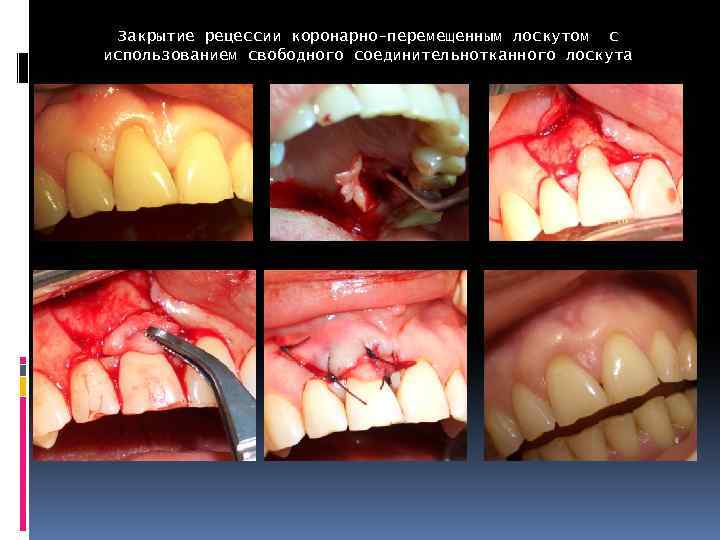 Закрытие рецессии коронарно-перемещенным лоскутом с использованием свободного соединительнотканного лоскута 