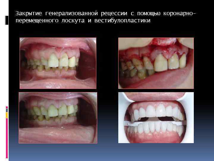 Закрытие генерализованной рецессии с помощью коронарноперемещенного лоскута и вестибулопластики 