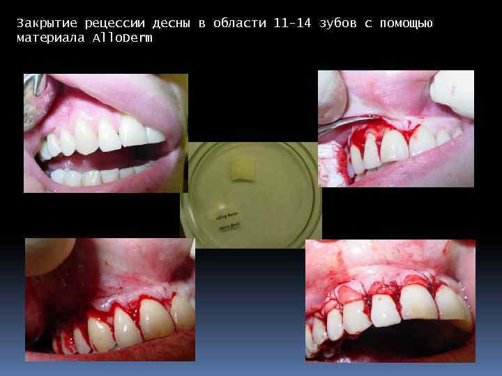 Закрытие рецессии десны в области 11 -14 зубов с помощью материала Allo. Derm 
