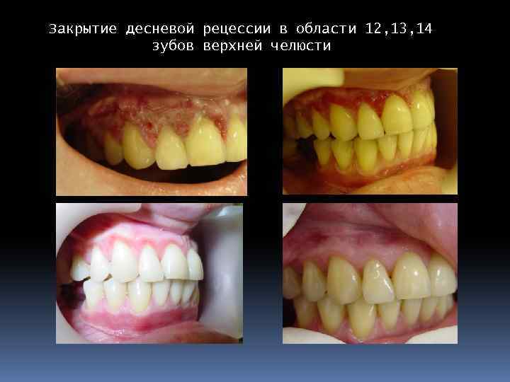 Закрытие десневой рецессии в области 12, 13, 14 зубов верхней челюсти 18. 02. 03