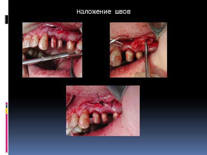 Наложение швов 