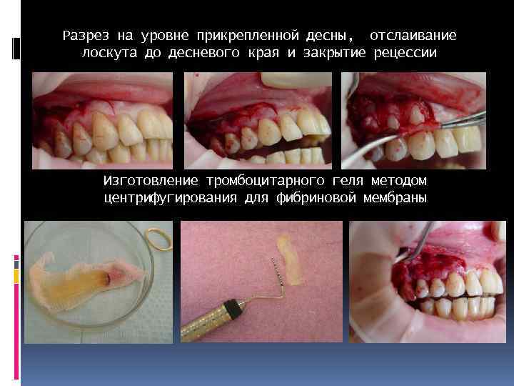 Разрез на уровне прикрепленной десны, отслаивание лоскута до десневого края и закрытие рецессии Изготовление