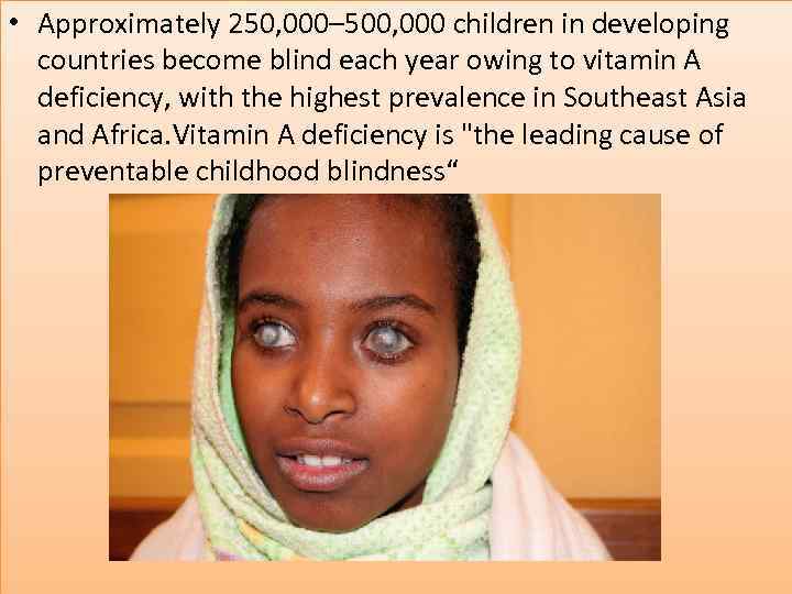  • Approximately 250, 000– 500, 000 children in developing countries become blind each