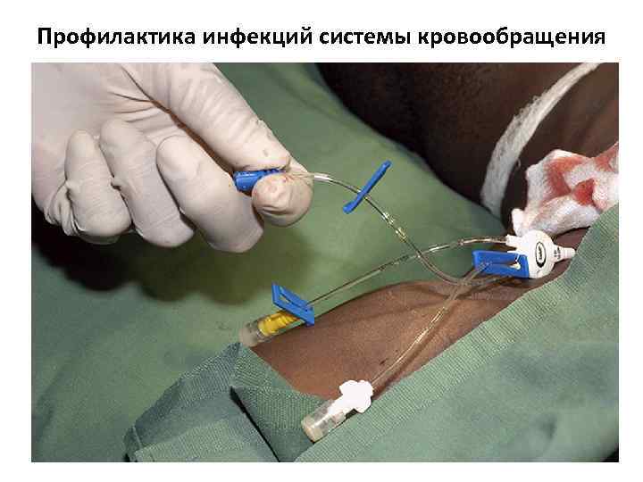 Профилактика инфекций системы кровообращения 