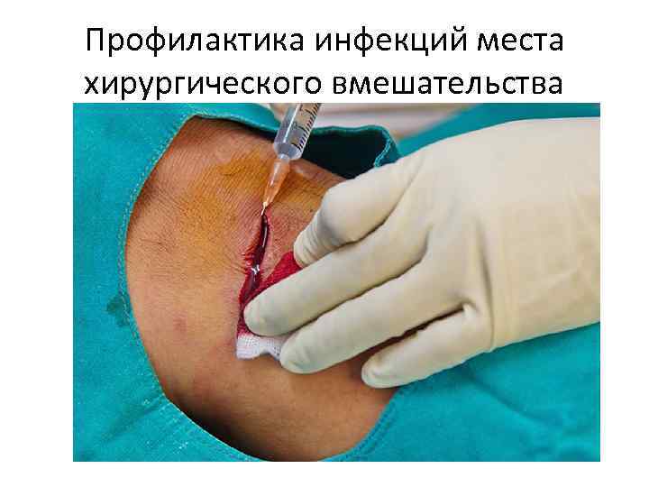 Профилактика инфекций места хирургического вмешательства 