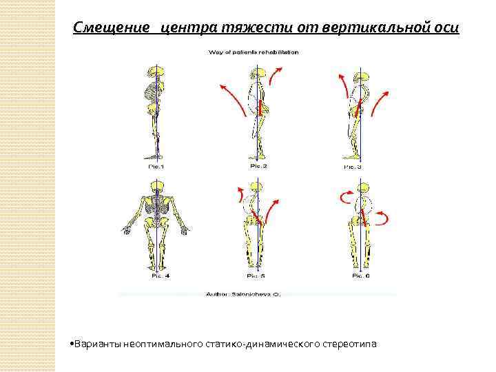 Смещенный центр тяжести. Смещение центра тяжести. Смещение центра тяжести у человека. Смещение общего центра тяжести.