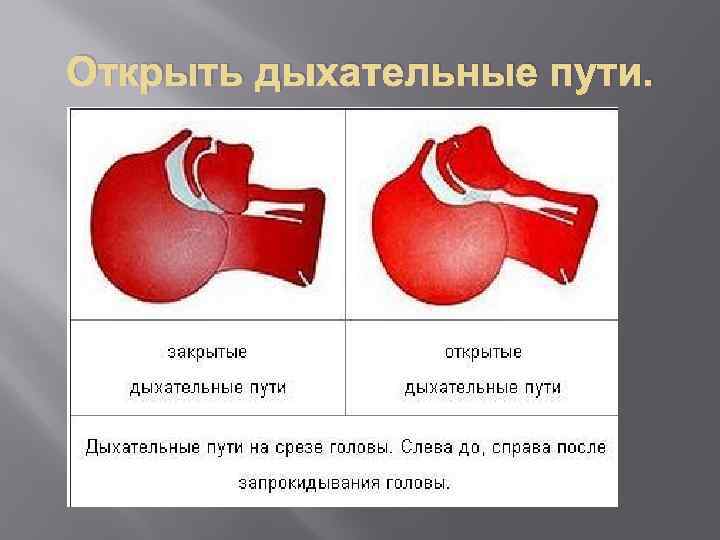 Открыть дыхательные пути. 