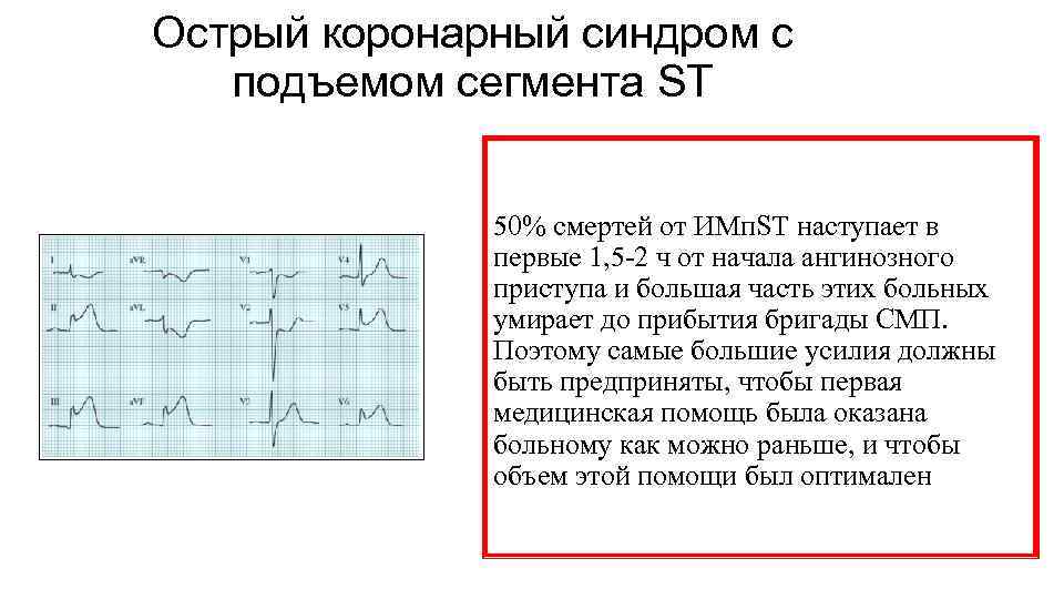 Острый коронарный синдром с подъемом сегмента ST 50% смертей от ИМп. ST наступает в