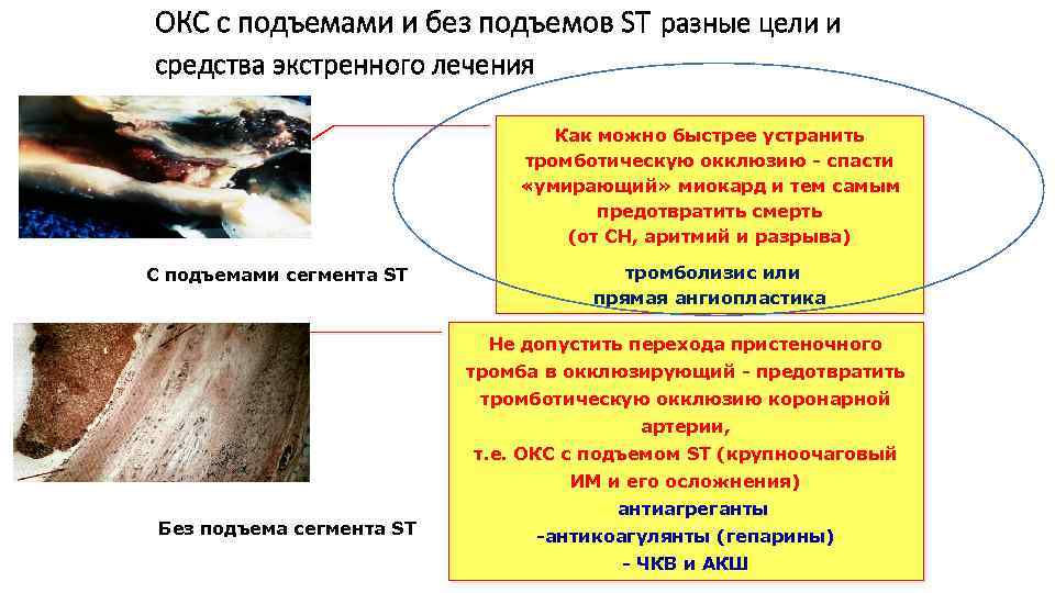 ОКС с подъемами и без подъемов ST разные цели и средства экстренного лечения Как