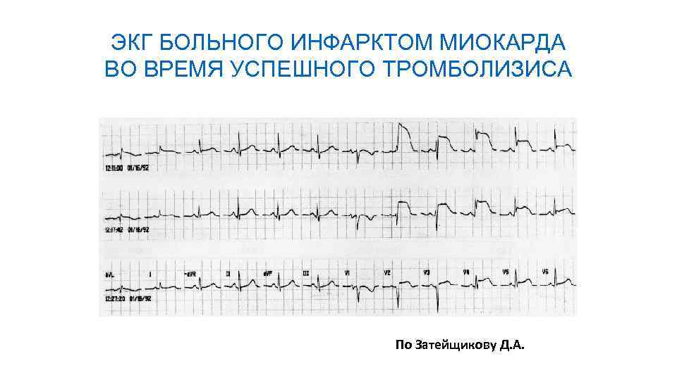 ЭКГ БОЛЬНОГО ИНФАРКТОМ МИОКАРДА ВО ВРЕМЯ УСПЕШНОГО ТРОМБОЛИЗИСА По Затейщикову Д. А. 