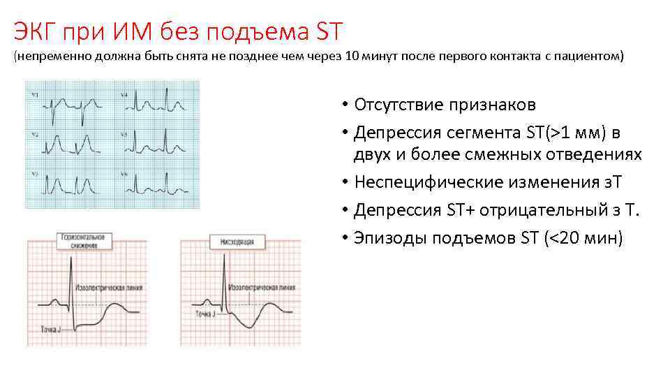 ЭКГ при ИМ без подъема ST (непременно должна быть снята не позднее чем через