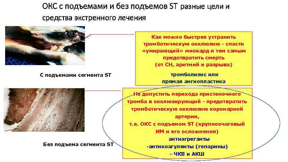 ОКС с подъемами и без подъемов ST разные цели и средства экстренного лечения Как