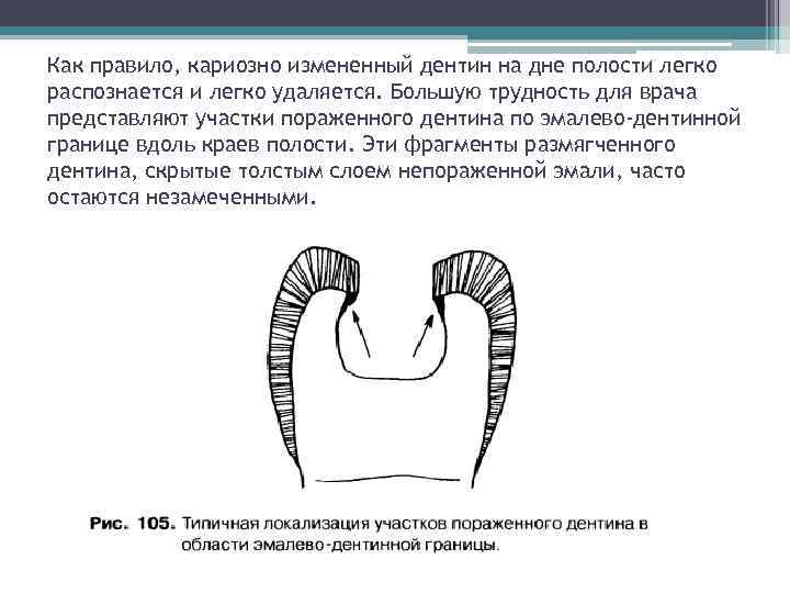 Как правило, кариозно измененный дентин на дне полости легко распознается и легко удаляется. Большую