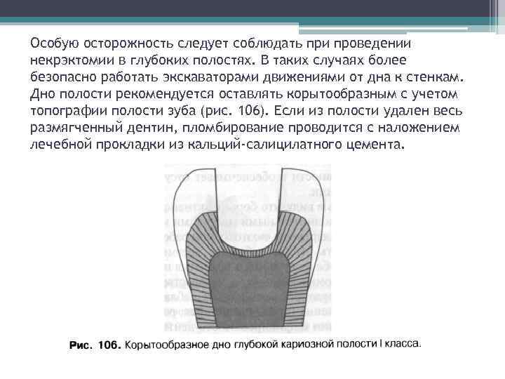 Препарирование кариозной полости 1 класса. Препарирование кариозных полостей 1 класса. Перфорация дна кариозной полости.