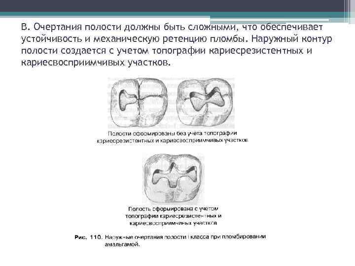 В. Очертания полости должны быть сложными, что обеспечивает устойчивость и механическую ретенцию пломбы. Наружный