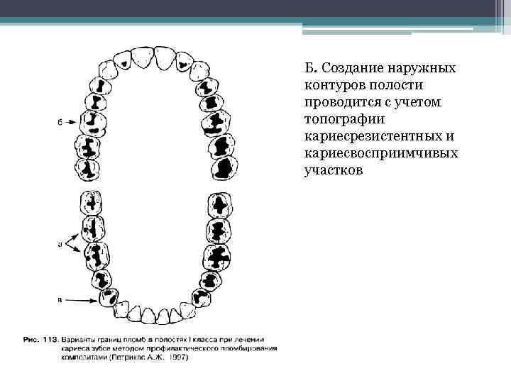 Б. Создание наружных контуров полости проводится с учетом топографии кариесрезистентных и кариесвосприимчивых участков 