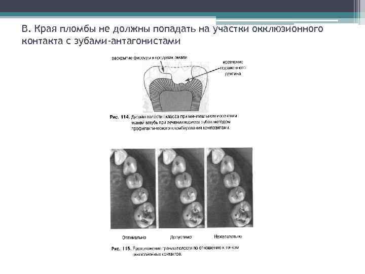 В. Края пломбы не должны попадать на участки окклюзионного контакта с зубами-антагонистами 