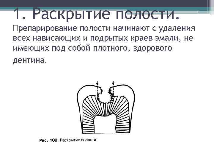 1. Раскрытие полости. Препарирование полости начинают с удаления всех нависающих и подрытых краев эмали,