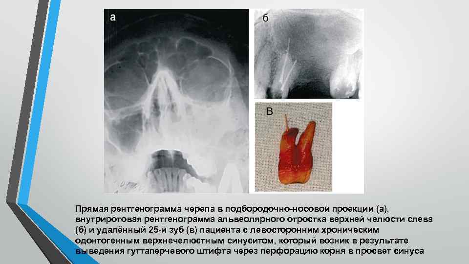 Прямая рентгенограмма черепа в подбородочно-носовой проекции (а), внутриротовая рентгенограмма альвеолярного отростка верхней челюсти слева