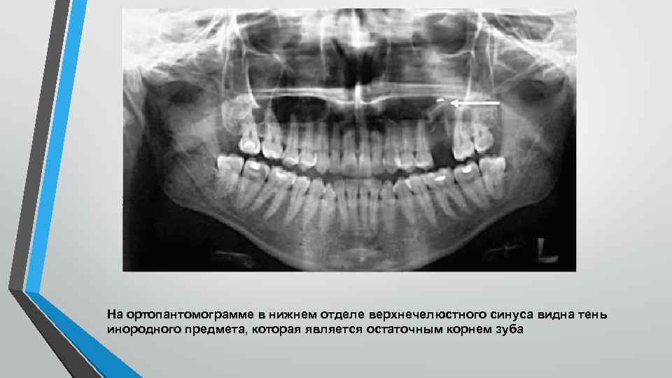 На ортопантомограмме в нижнем отделе верхнечелюстного синуса видна тень инородного предмета, которая является остаточным