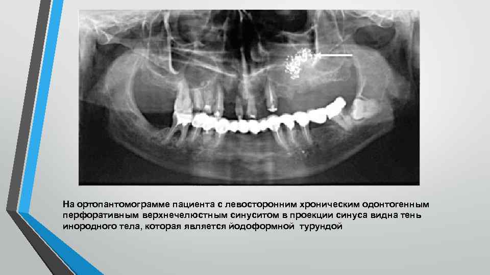 На ортопантомограмме пациента с левосторонним хроническим одонтогенным перфоративным верхнечелюстным синуситом в проекции синуса видна