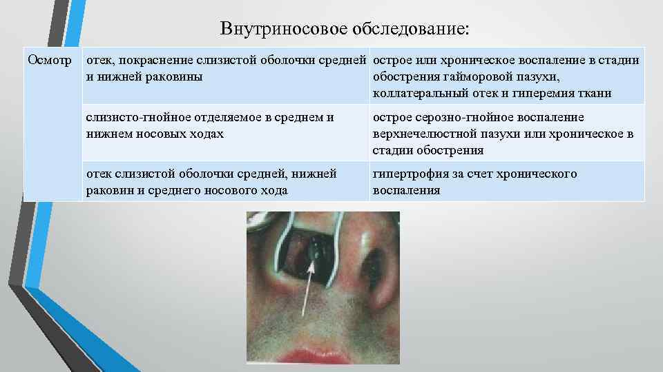 Внутриносовое обследование: Осмотр отек, покраснение слизистой оболочки средней острое или хроническое воспаление в стадии