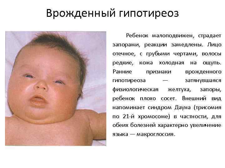 Врожденный гипотиреоз Ребенок малоподвижен, страдает запорами, реакции замедлены. Лицо отечное, с грубыми чертами, волосы