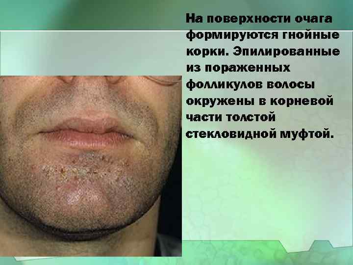 На поверхности очага формируются гнойные корки. Эпилированные из пораженных фолликулов волосы окружены в корневой