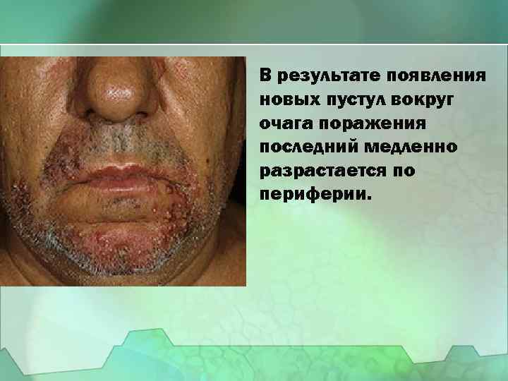 В результате появления новых пустул вокруг очага поражения последний медленно разрастается по периферии. 