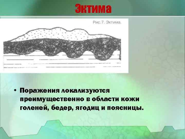 Эктима • Поражения локализуются преимущественно в области кожи голеней, бедер, ягодиц и поясницы. 