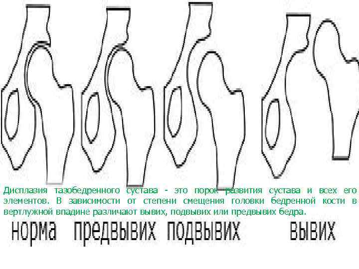 Дисплазия тазобедренного сустава причины