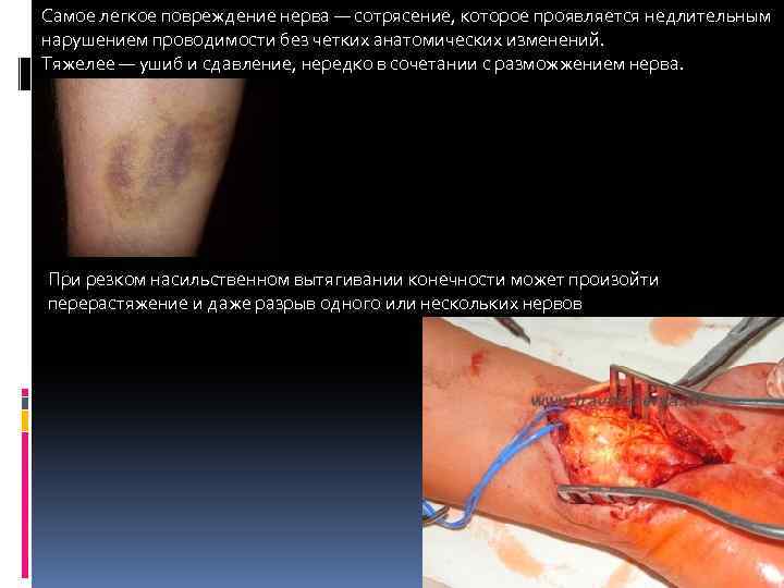 Самое легкое повреждение нерва — сотрясение, которое проявляется недлительным нарушением проводимости без четких анатомических