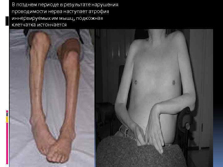 В позднем периоде в результате нарушения проводимости нерва наступает атрофия иннервируемых им мышц, подкожная