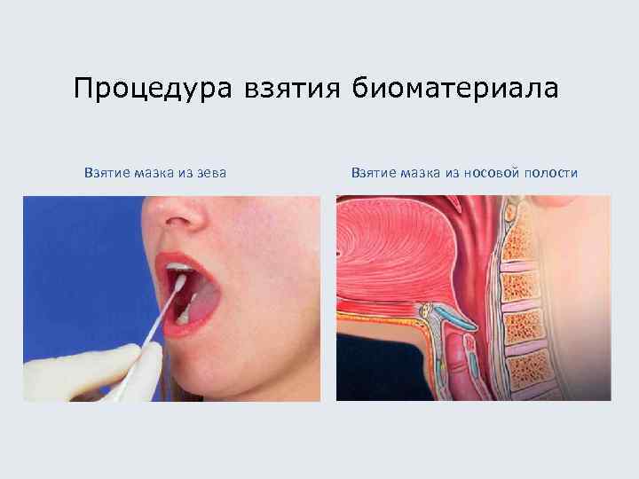 Процедура взятия биоматериала Взятие мазка из зева Взятие мазка из носовой полости 